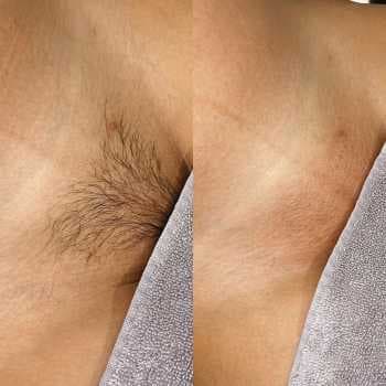 Brazilian Waxing